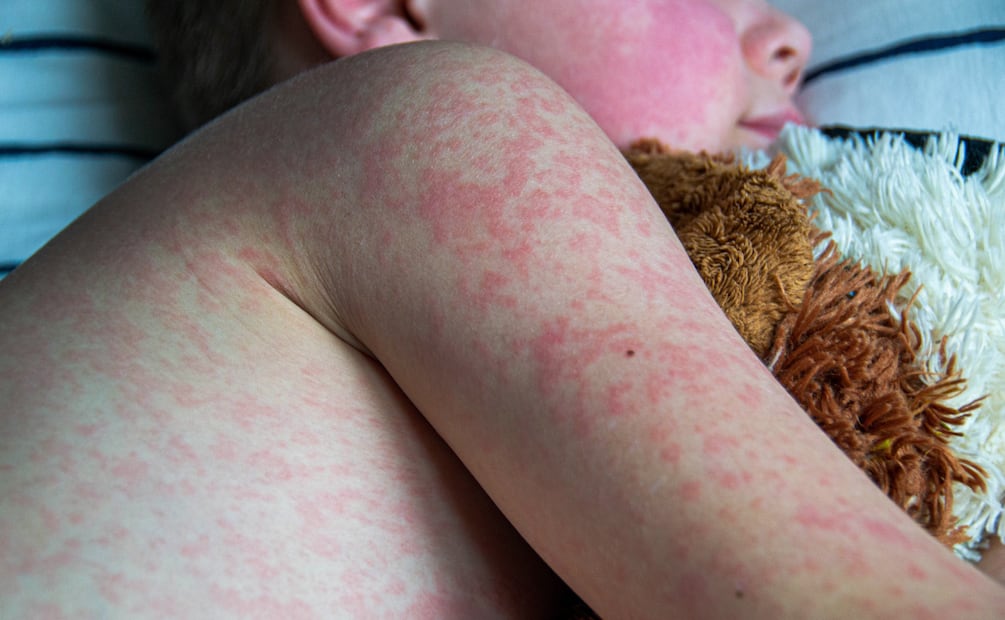 Hidalgo cuenta con más de 190 mil dosis para prevenir brotes de sarampión en niños | Imagen ilustrativa