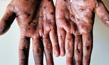 Brote de mpox: ¿Cuándo llegó la viruela del mono a México y cuántos contagios ha sumado?