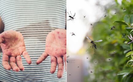 Hidalgo refuerza medidas sanitarias ante riesgo de sarampión y repunte de dengue