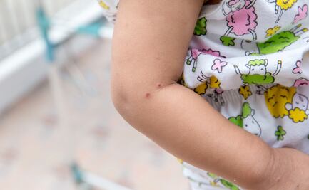 Brote de virus Coxsackie afecta a 400 estudiantes en Hidalgo