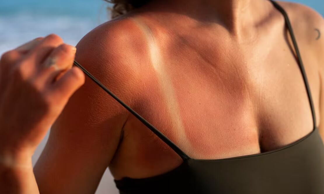 Quemaduras de sol en la piel. Foto: Freepik