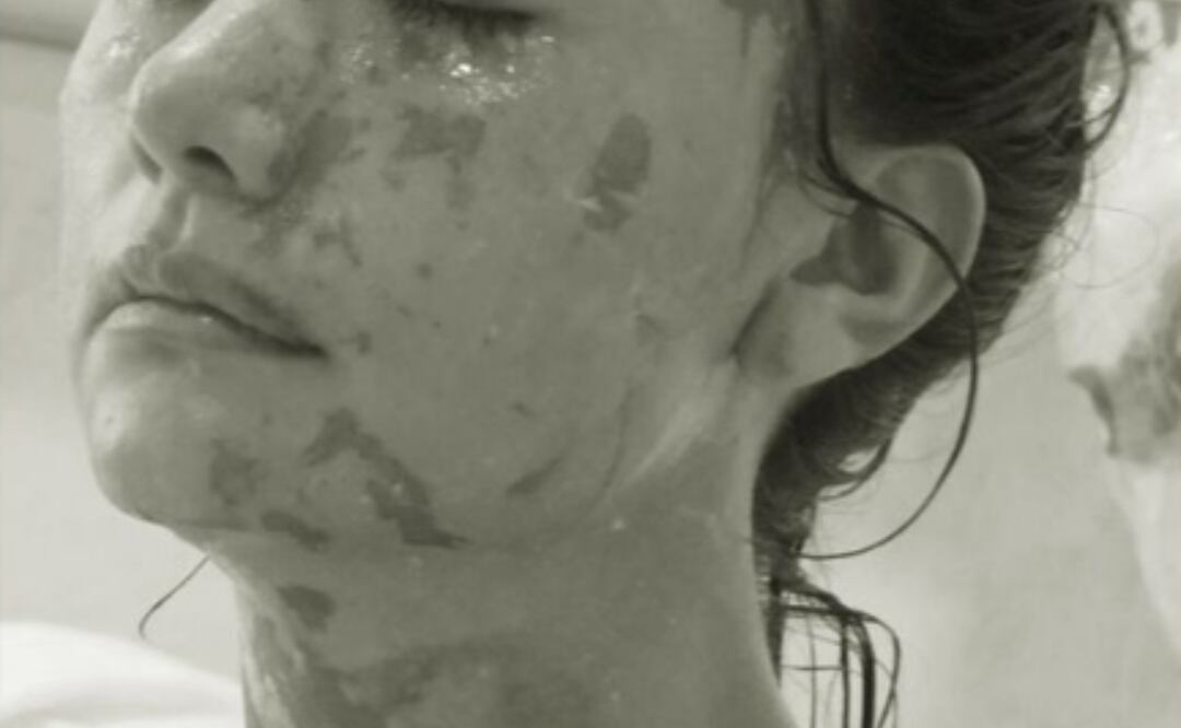 La joven quedó marcada de su rostro luego del ataque y sigue esperando se le haga justicia | Foto: Especial