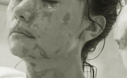 “El sistema enmascara la injusticia como justicia”: Leslie, sobreviviente de ataque con ácido