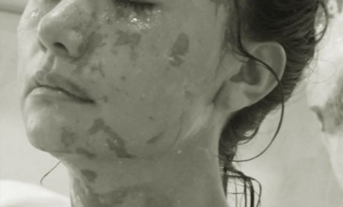 La joven quedó marcada de su rostro luego del ataque y sigue esperando se le haga justicia | Foto: Especial