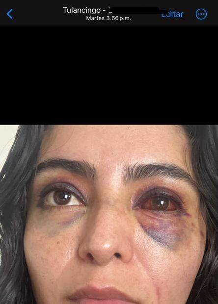 Ivet O. quien mostró fotografías de las agresiones físicas que recibió por parte de su pareja sentimental,