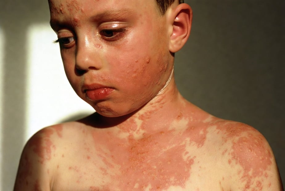 Hidalgo suma 11 casos de sarampión en el primer bimestre del año | Imagen generada con Grok