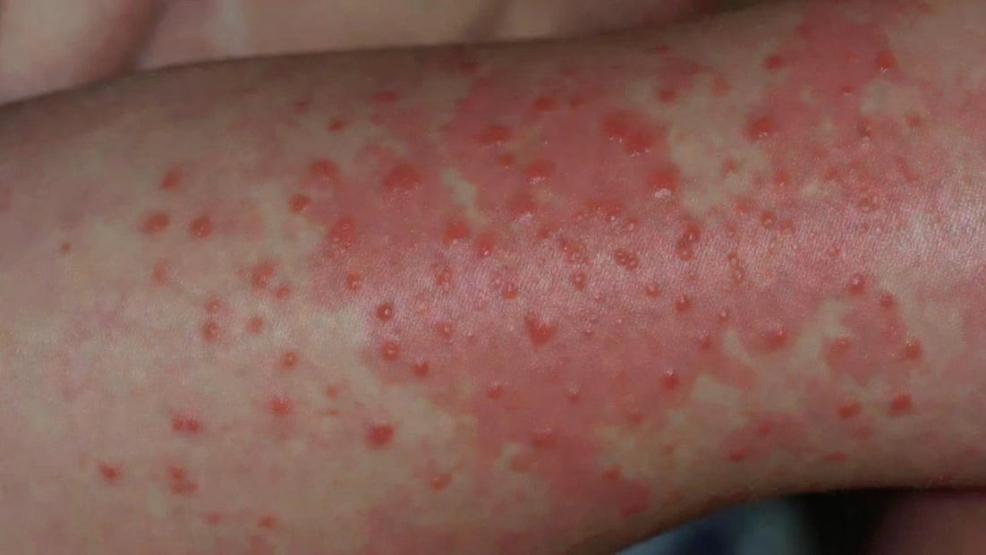 Confirman dos nuevos casos de sarampión en Hidalgo durante el periodo 2025–2026 | Imagen creada con IA