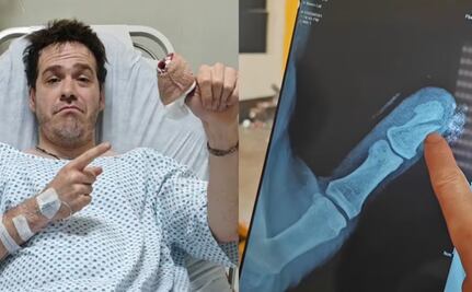 Tiktoker sufre accidente al poner a prueba herramienta de jardinería; “la tijera cortó mi hueso, lo partió en dos” 