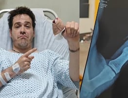 Tiktoker sufre accidente al poner a prueba herramienta de jardinería; “la tijera cortó mi hueso, lo partió en dos”
