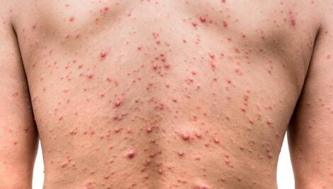 Brote de mpox, antes viruela del mono, en África incluye diferentes variantes y modos de transmisión: OMS