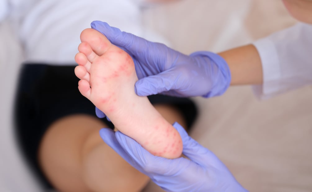 Reitera Salud Hidalgo medidas preventivas ante casos de enfermedad “manos, pies y boca” | Imagen ilustrativa