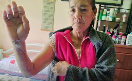 Médicos de IMSS Bienestar evitan amputación tras mordedura de araña violinista en Hidalgo