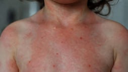 Hidalgo suma 14 casos de sarampión en 2026; tres contagios se confirmaron en marzo