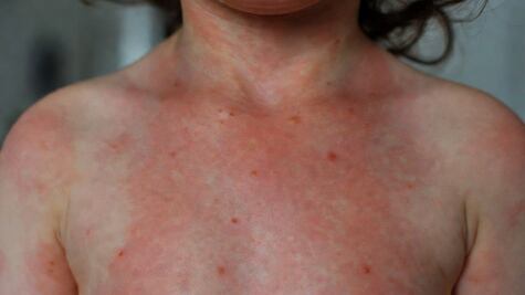 Hidalgo suma 14 casos de sarampión en 2026; tres contagios se confirmaron en marzo