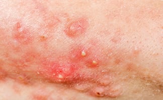 Llaman a reforzar filtros escolares y familiares ante casos de sarampión en Hidalgo