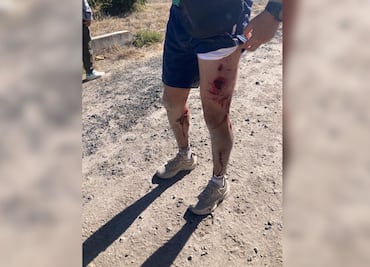Jauría ataca a joven en Tizayuca; vecinos alertan por aumento de incidentes