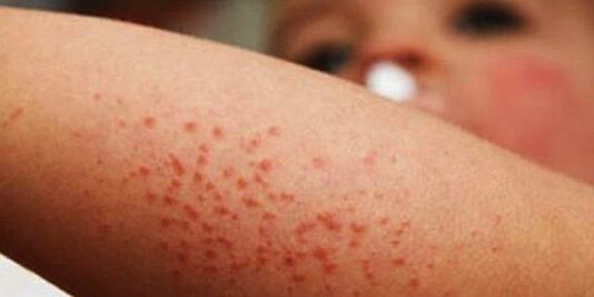 ¿Cómo es el Coxsackie? el virus que pone en alerta a Hidalgo