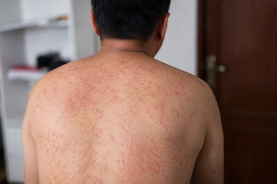 Adultos concentran casi el 70% de los casos de sarampión en Hidalgo; Pachuca lidera los contagios