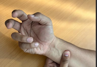 Implementan acciones en Hidalgo para evitar un brote del Síndrome de Guillain-Barré