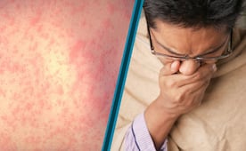 Advierte SSH sobre riesgos de sarampión y males respiratorios tras periodo vacacional