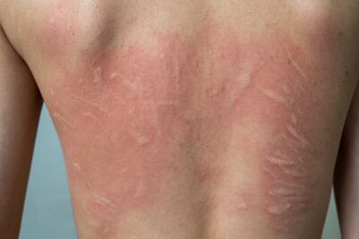 Consejos para combatir la urticaria crónica