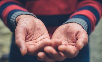 Reitera Salud Hidalgo medidas preventivas ante casos de enfermedad “manos, pies y boca”