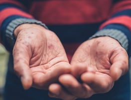 Reitera Salud Hidalgo medidas preventivas ante casos de enfermedad “manos, pies y boca”