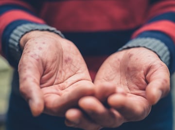 Reitera Salud Hidalgo medidas preventivas ante casos de enfermedad “manos, pies y boca”