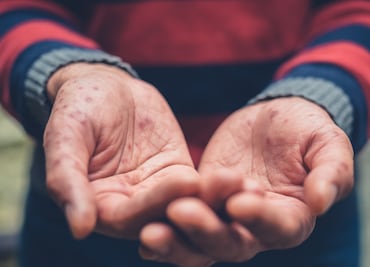 Reitera Salud Hidalgo medidas preventivas ante casos de enfermedad “manos, pies y boca”