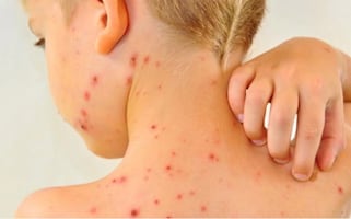 Brote de sarampión alcanza 7 mil 131 casos confirmados en México; Ssa aplica más de 11.8 millones de vacunas en 2025 y 2026 