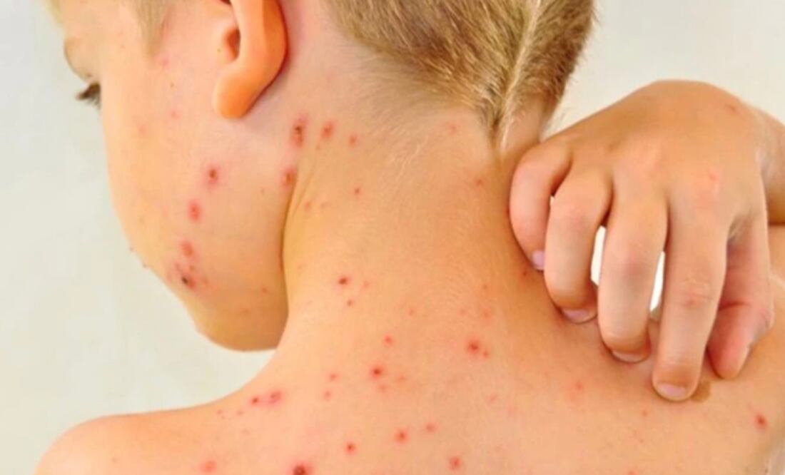 Se ejecuta protocolo de vigilancia epidemiológica y control ante caso de sarampión Foto: Gob. San Luis