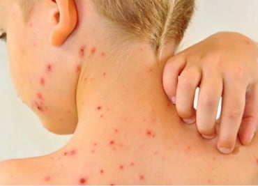 Una persona con sarampión puede infectar hasta 18 sin vacuna