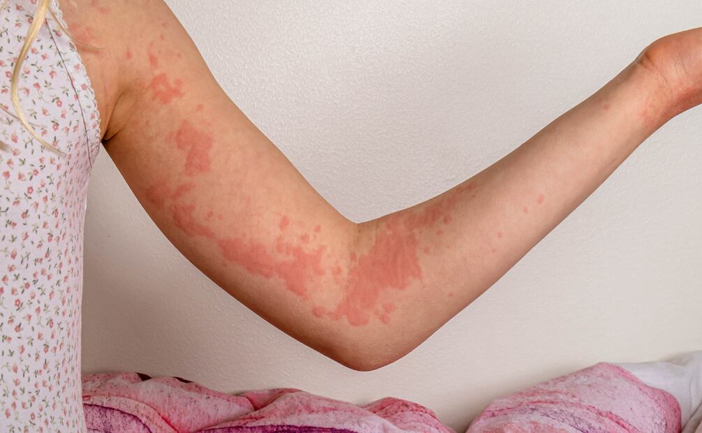 Aumentan casos de fiebre escarlata en Hidalgo; autoridades refuerzan medidas preventivas | imagen ilustrativa