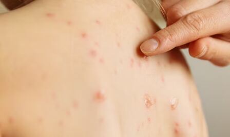 La Secretaría de Salud estatal confirma el primer caso de sarampión en Hidalgo