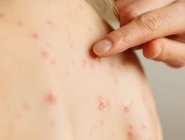 La Secretaría de Salud estatal confirma el primer caso de sarampión en Hidalgo