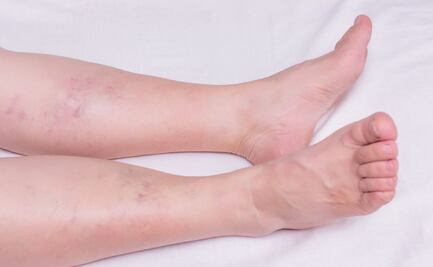 Tratamiento contra la trombosis