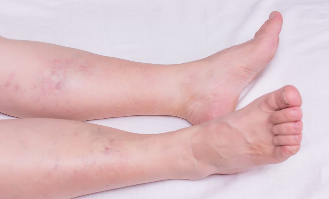 ¿Cuál es el tratamiento de la trombosis, efecto secundario de la vacuna AstraZeneca? | Imagen ilustrativa