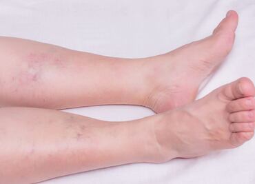 Tratamiento contra la trombosis