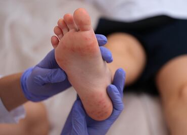 ¿Qué es el virus Coxsackie y cómo afecta a tu hijo?