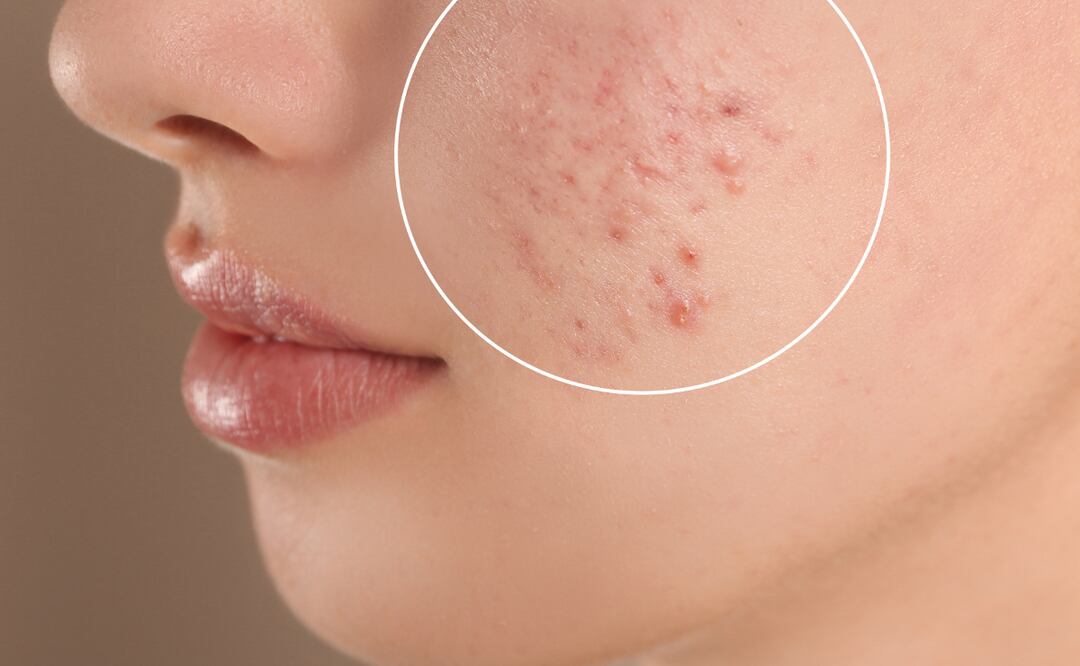 Lo ideal para evitar la aparición del acné es una buena higiene de piel | Imagen ilustrativa