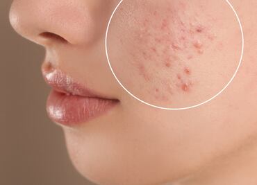 Recomendaciones para tratar las cicatrices de acné en la piel