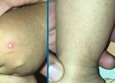 Confirman otros dos casos de Coxsackie; ya van 8 en Hidalgo