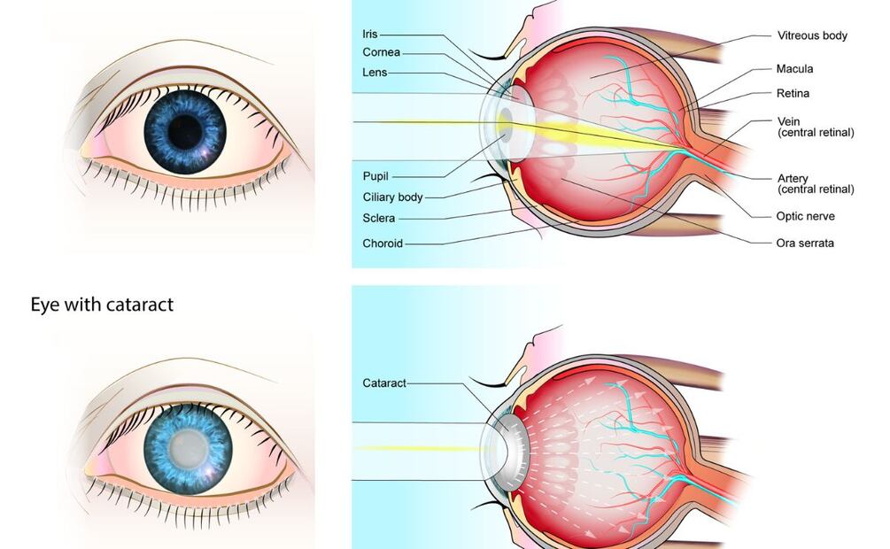 Cataratas y glaucoma, entre los males visuales más frecuentes en Tulancingo | Infografía: Science Photo Library