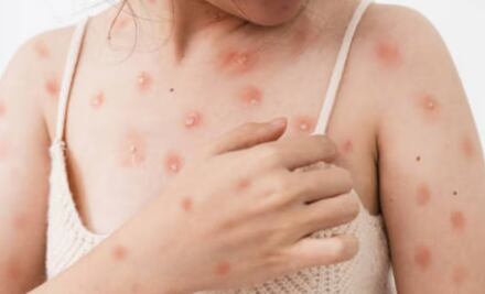 Brote mpox: ¿Cómo prevenir la viruela del mono?