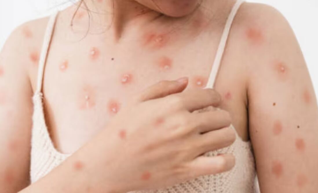 La viruela símica, es considerada una enfermedad infecciosa, generada por un virus que provoca erupciones dolorosas Foto: Istock