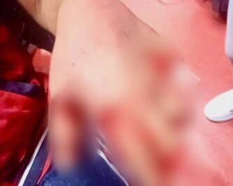 Niño de Pachuca pierde dedos de sus manos por jugar con pirotecnia